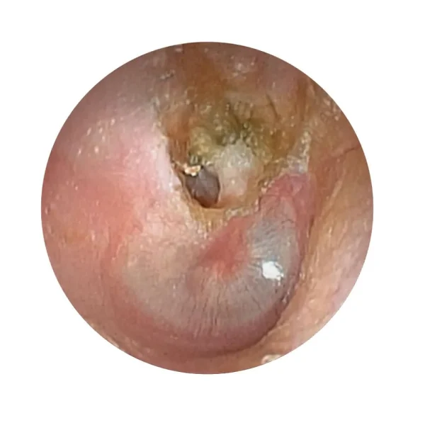 مانکن معاینات گوش (اتوسکوپی)