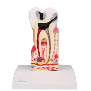 مولاژ پوسیدگی دندان