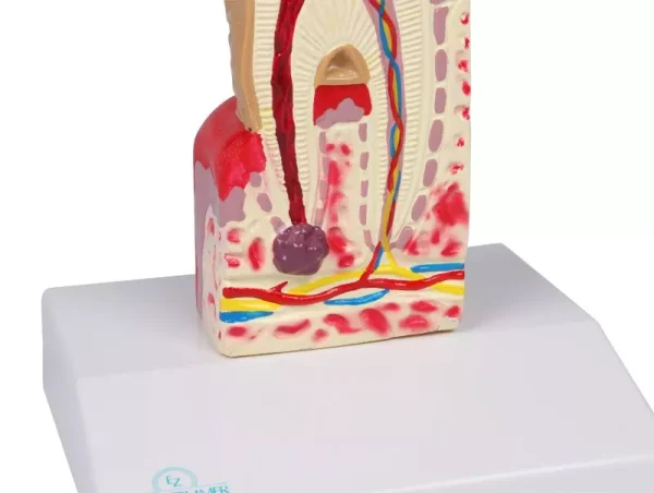 مولاژ پوسیدگی دندان