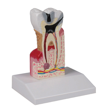 مولاژ پوسیدگی دندان