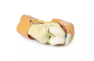 مولاژ نمایش سه بعدی مفصل زانو